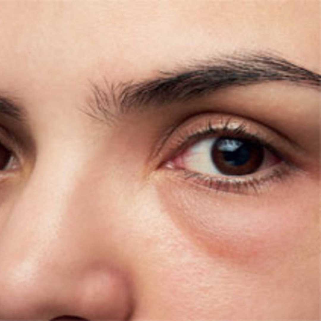 Why Do I Get Swollen Eyes in the Morning? Causes & Treatments