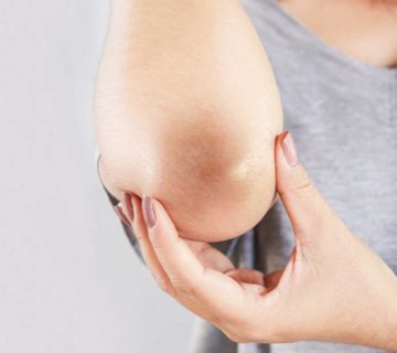 How to Lighten Dark Knees and Elbows Naturally