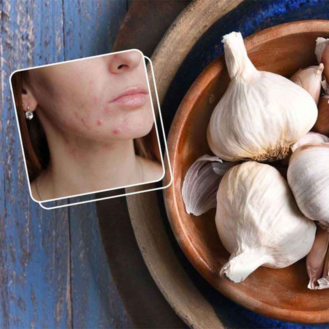 Garlic for Acne | Does Garlic Help Acne?