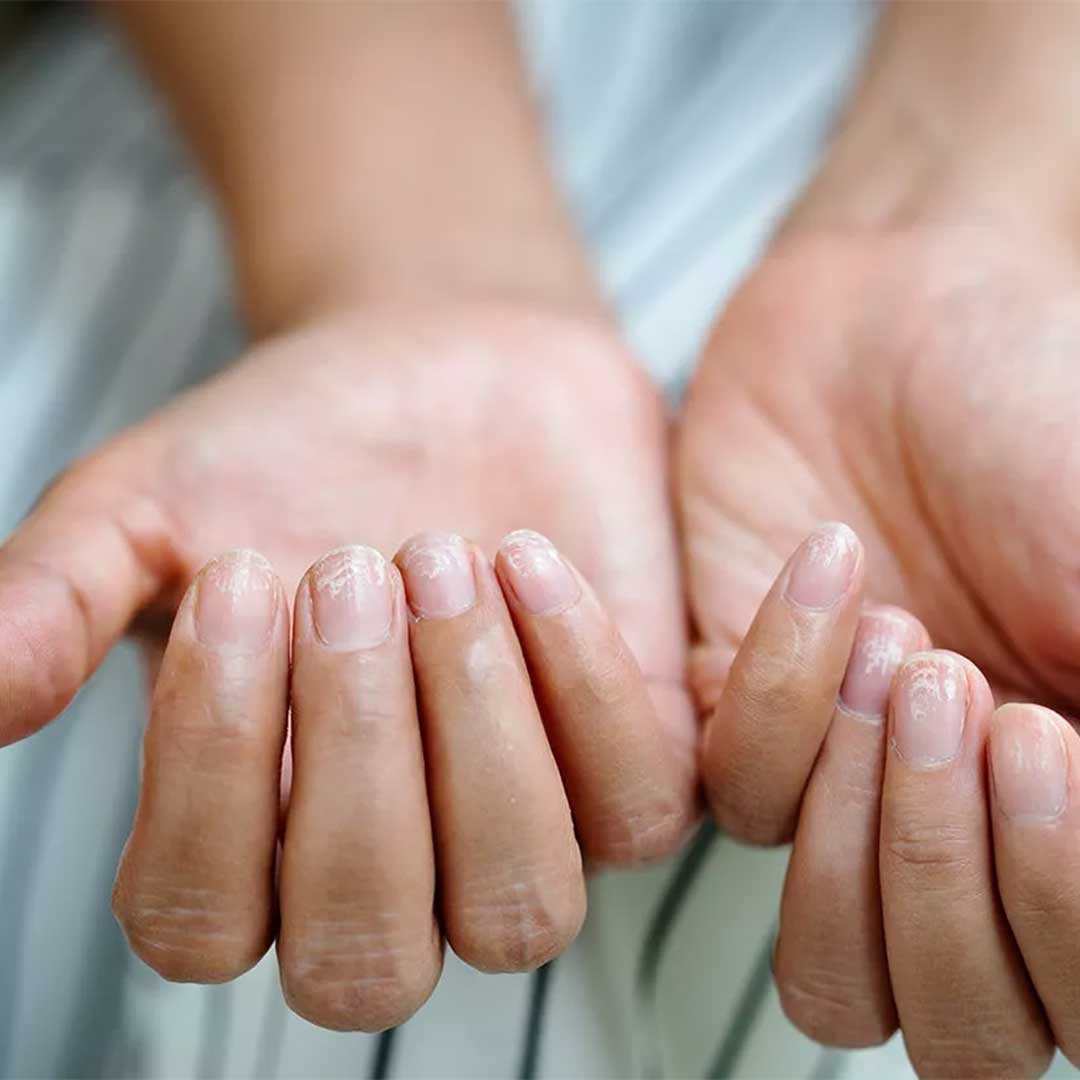 Nail Care for People with Psoriasis or Eczema